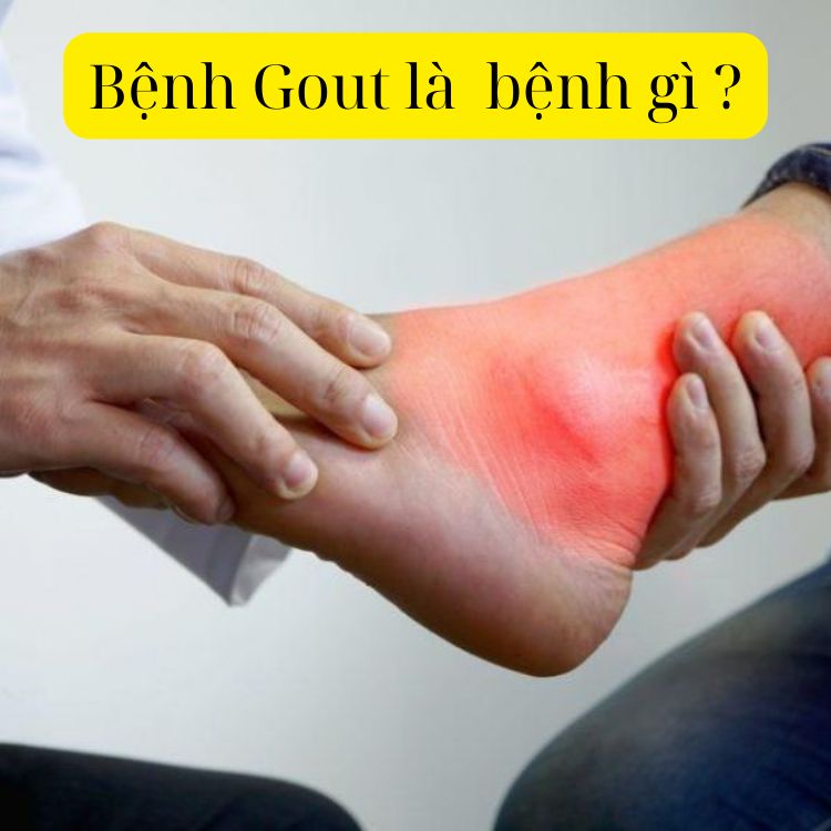 benh-gout-la-benh-gi